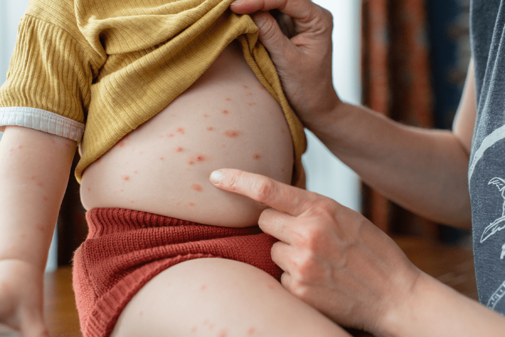 chickenpox vaccine